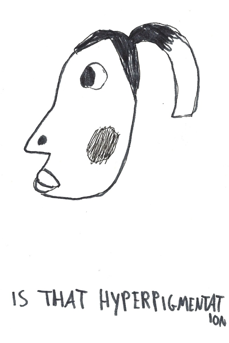 Is that hyperpigmentation - (like the meme) girl with a ponytail and hyperpigmentation on her cheek