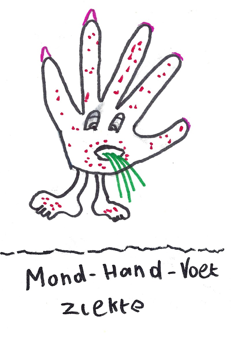 Mond-hand-voet ziekte - A hand with a face on its palm and feet, fully covered in red dots, puking